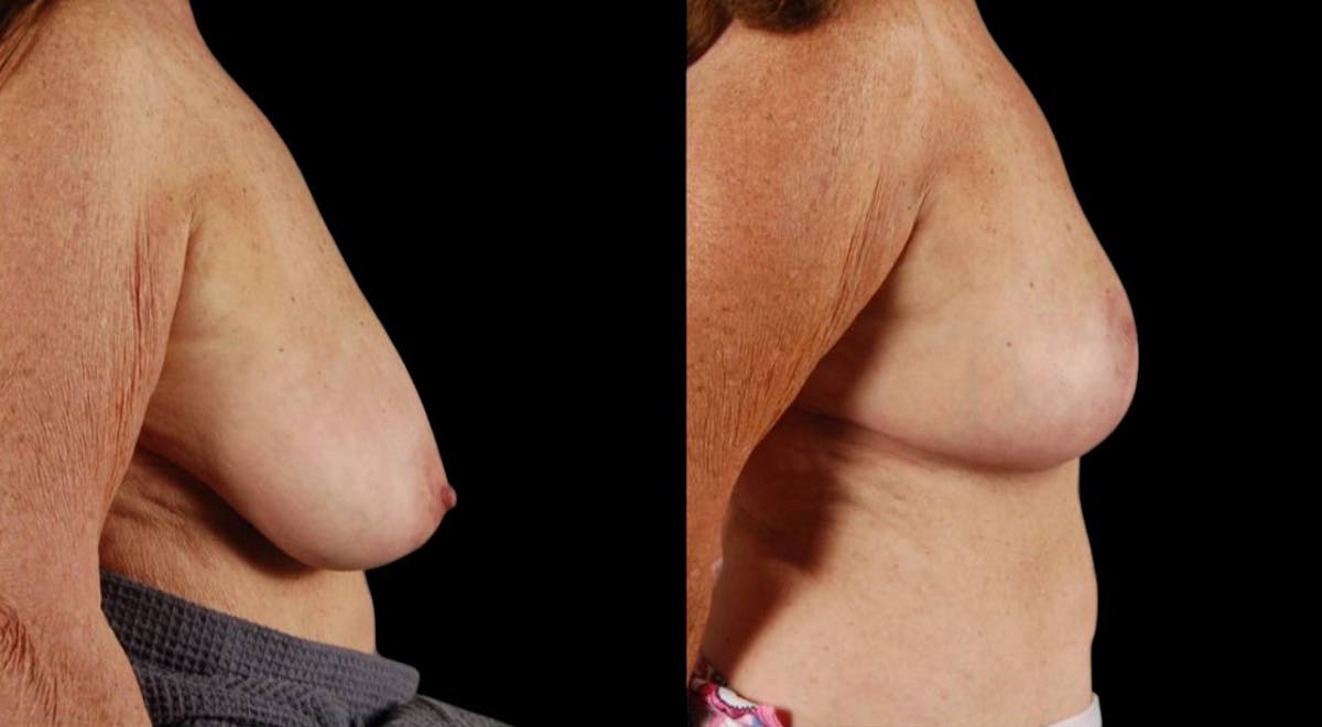 Breast Reduction Before & After Gallery - Patient 255984 - Image 3