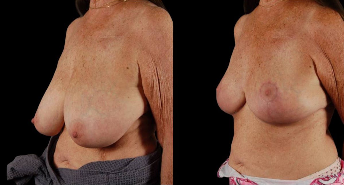 Breast Reduction Before & After Gallery - Patient 255984 - Image 4