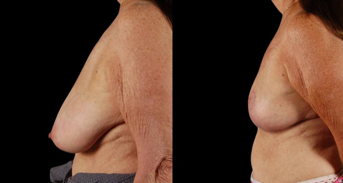 Breast Reduction Before & After Gallery - Patient 255984 - Image 5