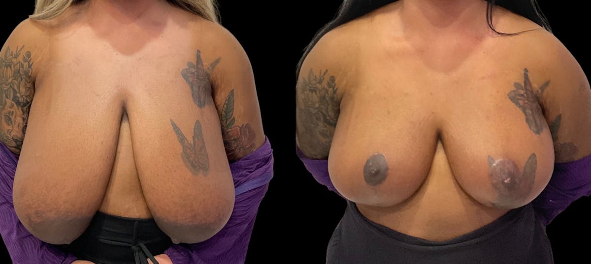 Breast Reduction Before & After Gallery - Patient 112481 - Image 1