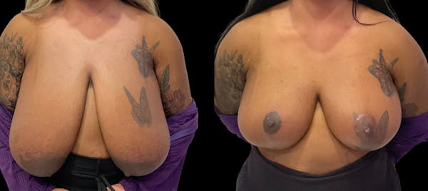 Breast Reduction Before & After Gallery - Patient 112481 - Image 1