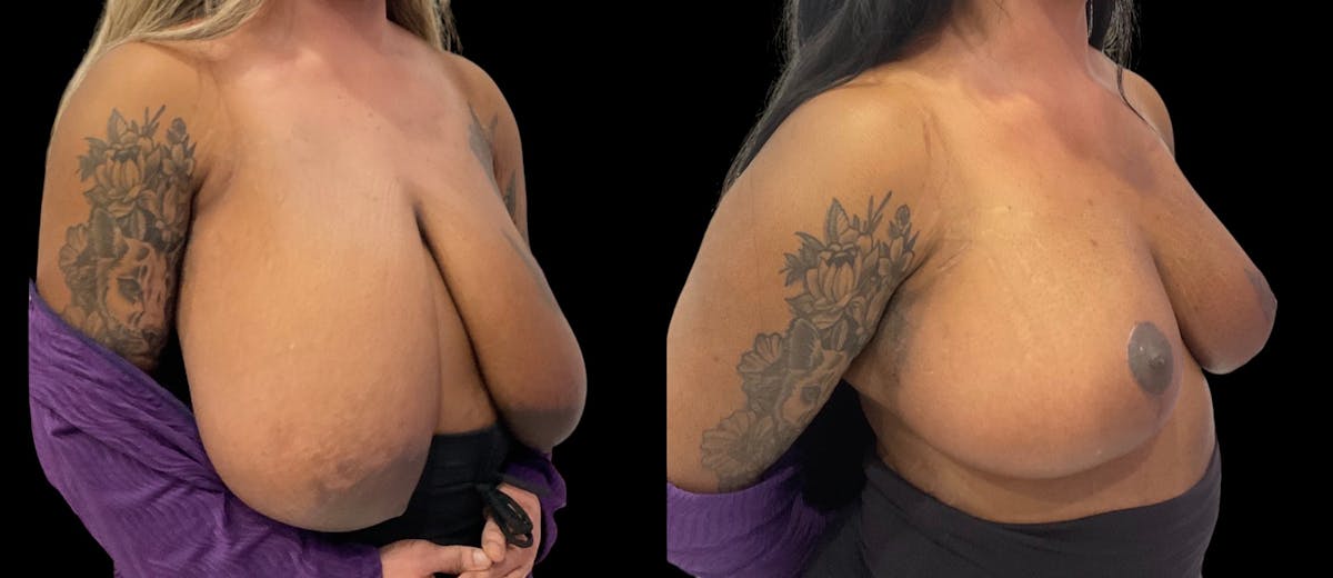 Breast Reduction Before & After Gallery - Patient 112481 - Image 2