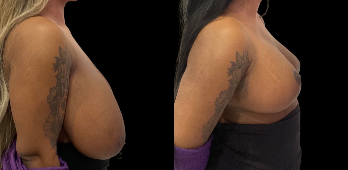 Breast Reduction Before & After Gallery - Patient 112481 - Image 3