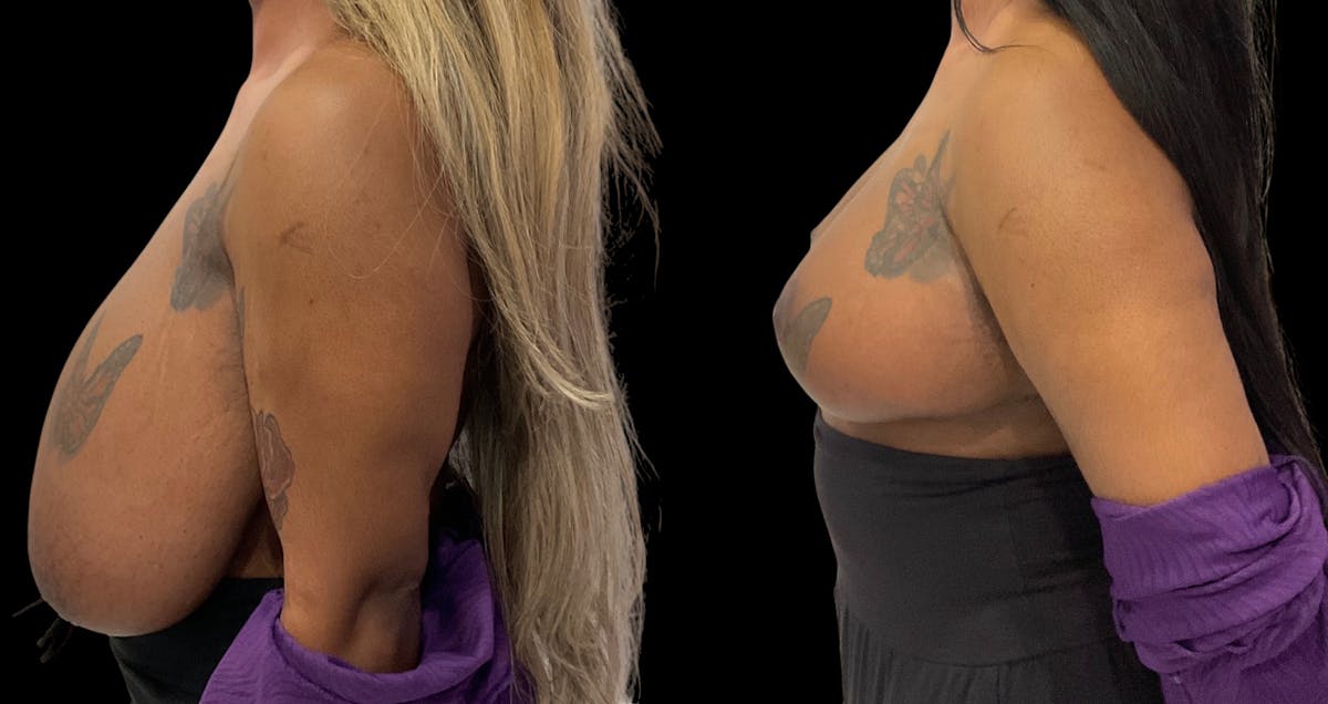 Breast Reduction Before & After Gallery - Patient 112481 - Image 4