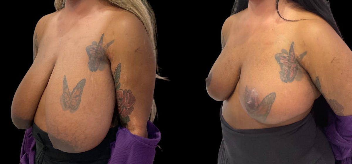 Breast Reduction Before & After Gallery - Patient 112481 - Image 5