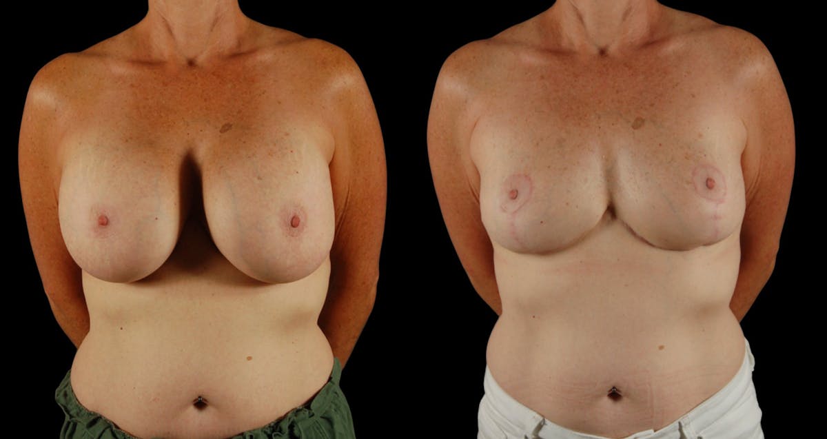 Breast Reduction Before & After Gallery - Patient 110961 - Image 1