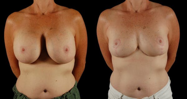 Breast Reduction Before & After Gallery - Patient 110961 - Image 1