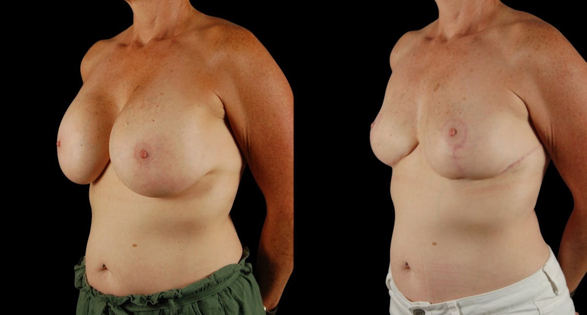 Breast Reduction Before & After Gallery - Patient 110961 - Image 2