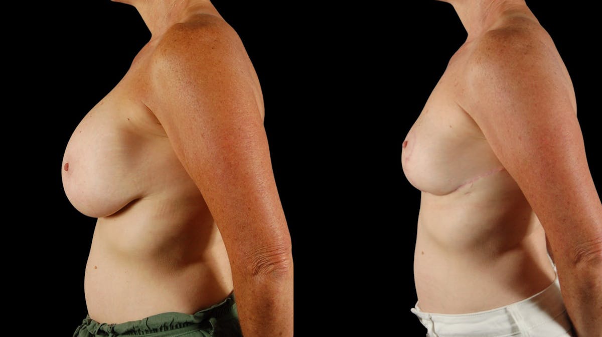 Breast Reduction Before & After Gallery - Patient 110961 - Image 3