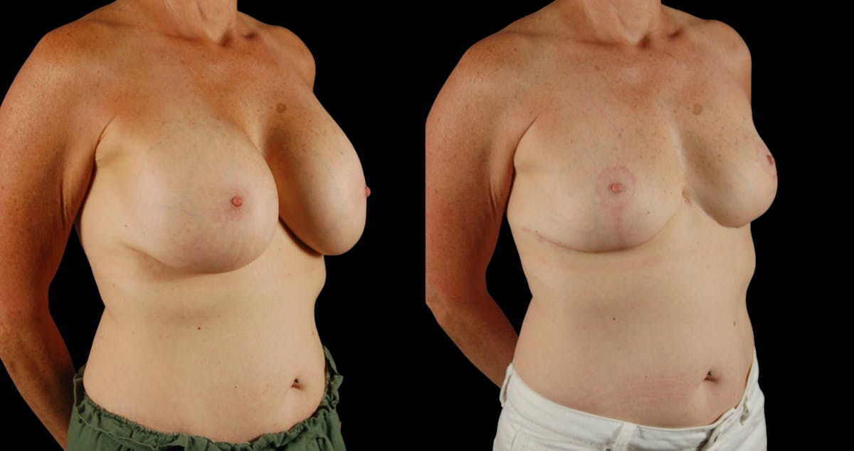 Breast Reduction Before & After Gallery - Patient 110961 - Image 4