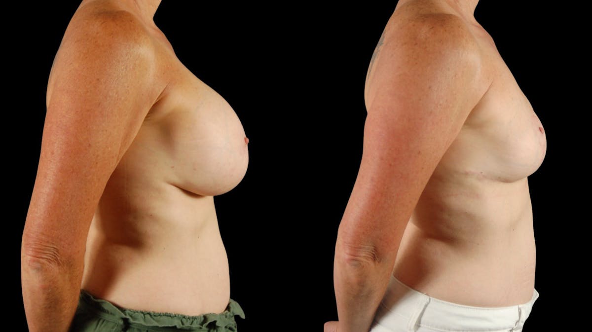 Breast Reduction Before & After Gallery - Patient 110961 - Image 5