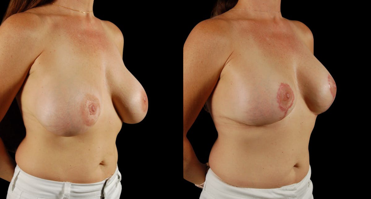 Breast Reduction Before & After Gallery - Patient 131840 - Image 4