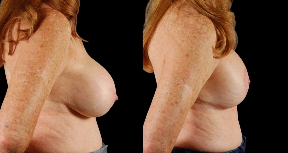 Breast Reduction Before & After Gallery - Patient 202122 - Image 3