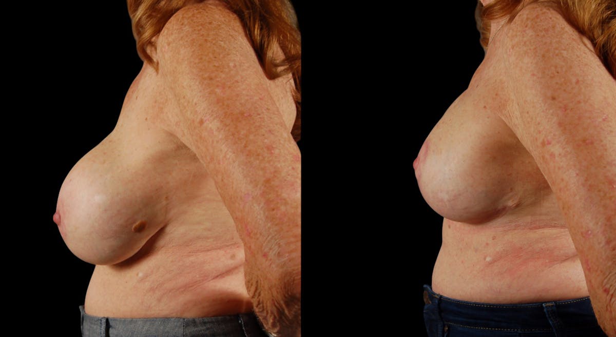 Breast Reduction Before & After Gallery - Patient 202122 - Image 5