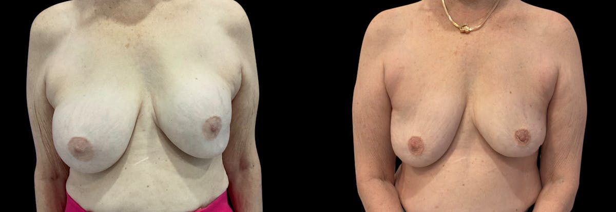 Capsular Contracture Before & After Gallery - Patient 339253 - Image 1