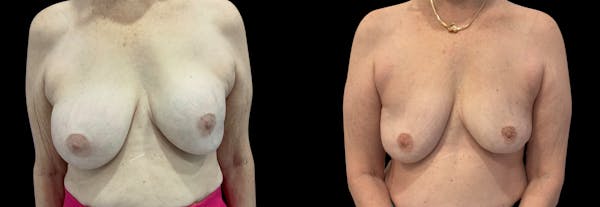 Capsular Contracture Before & After Gallery - Patient 339253 - Image 1