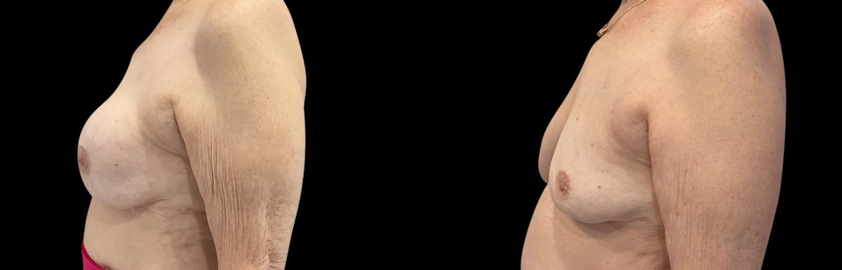 Capsular Contracture Before & After Gallery - Patient 339253 - Image 2
