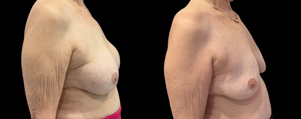 Capsular Contracture Before & After Gallery - Patient 339253 - Image 3