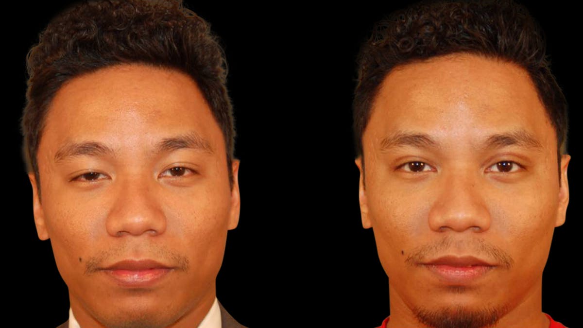 Asian Eyelid Surgery Before & After Gallery - Patient 258927 - Image 1