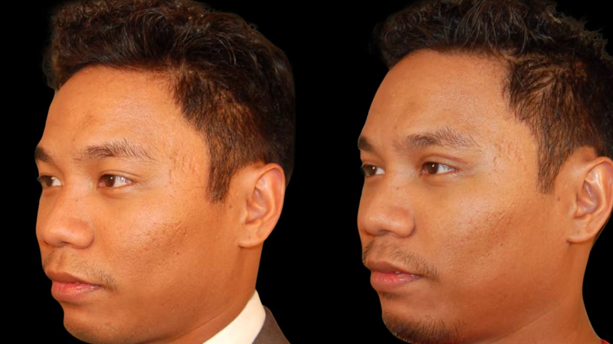 Asian Eyelid Surgery Before & After Gallery - Patient 258927 - Image 2