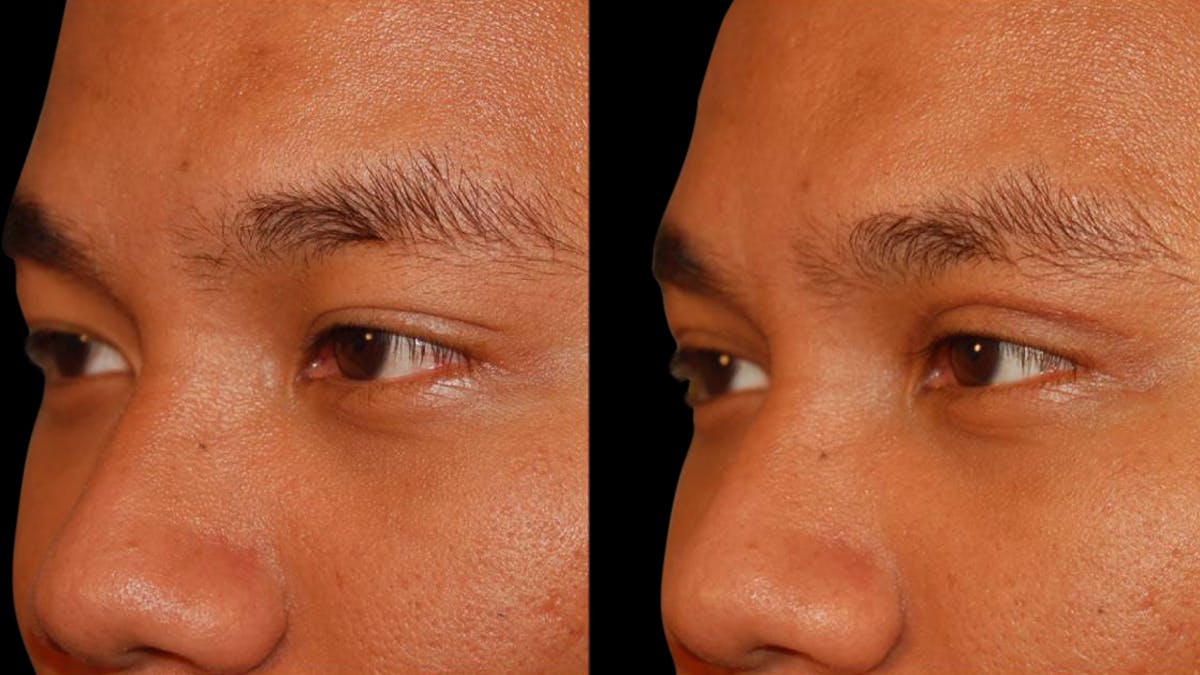 Asian Eyelid Surgery Before & After Gallery - Patient 258927 - Image 3