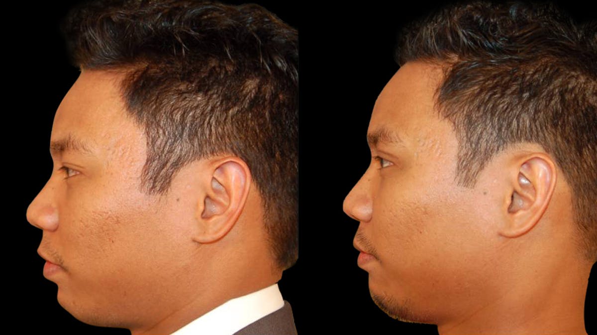 Asian Eyelid Surgery Before & After Gallery - Patient 258927 - Image 4