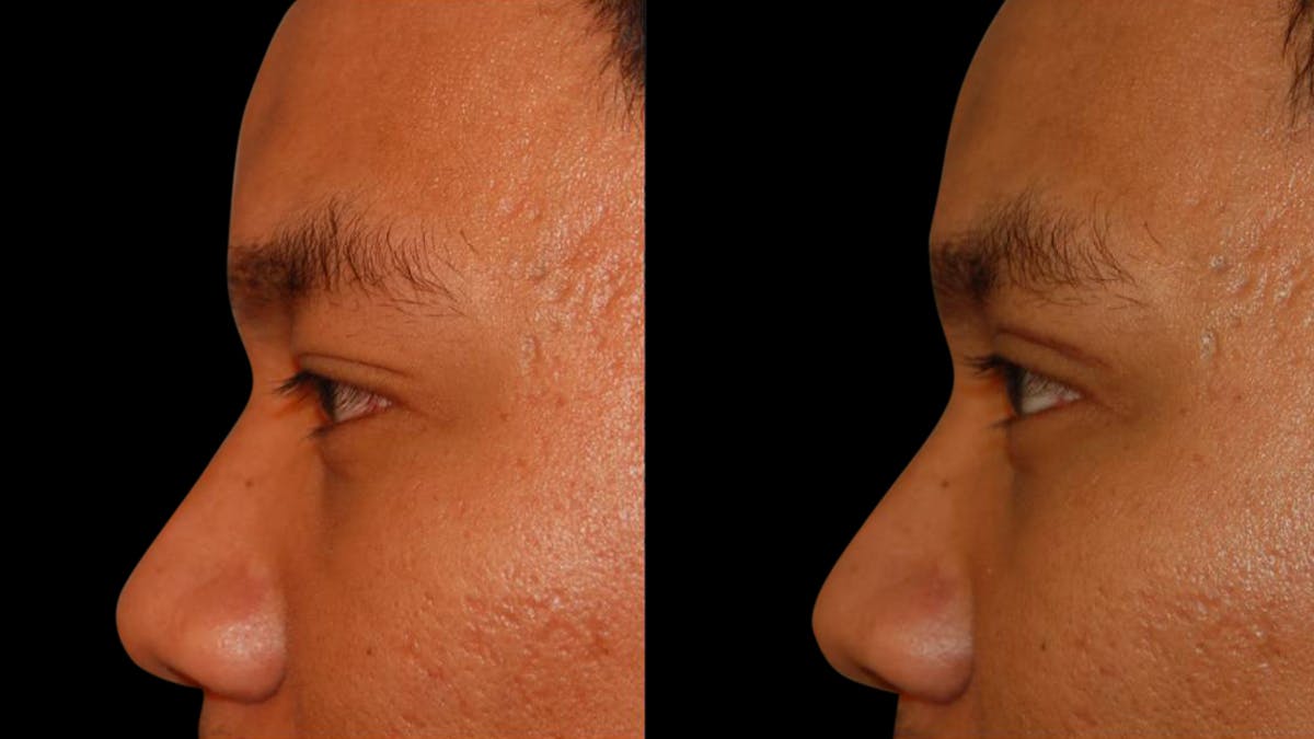 Asian Eyelid Surgery Before & After Gallery - Patient 258927 - Image 5