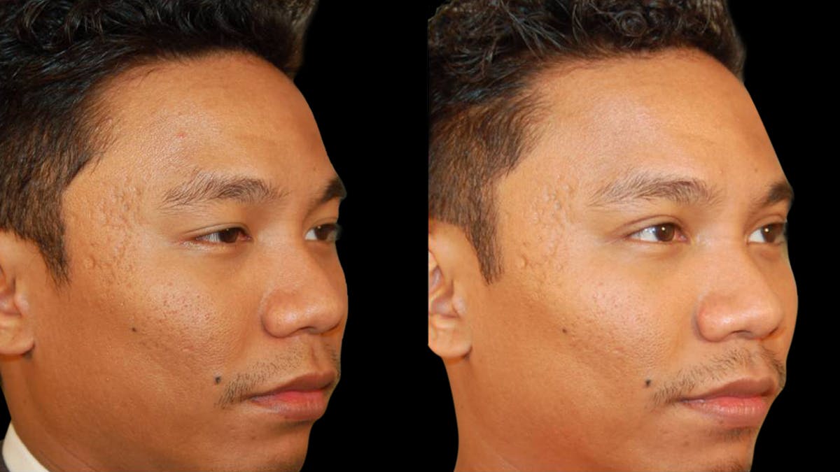 Asian Eyelid Surgery Before & After Gallery - Patient 258927 - Image 6