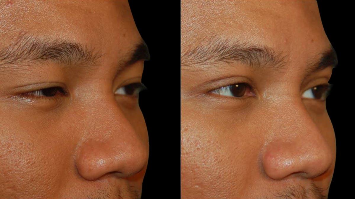 Asian Eyelid Surgery Before & After Gallery - Patient 258927 - Image 7