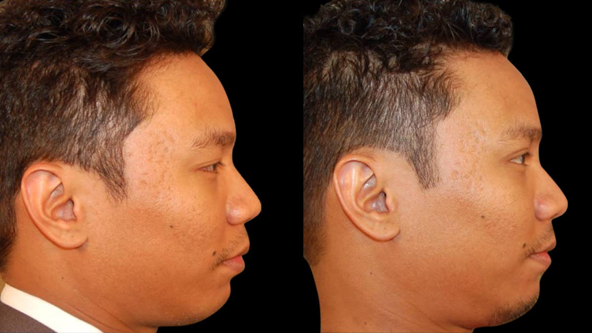 Asian Eyelid Surgery Before & After Gallery - Patient 258927 - Image 8