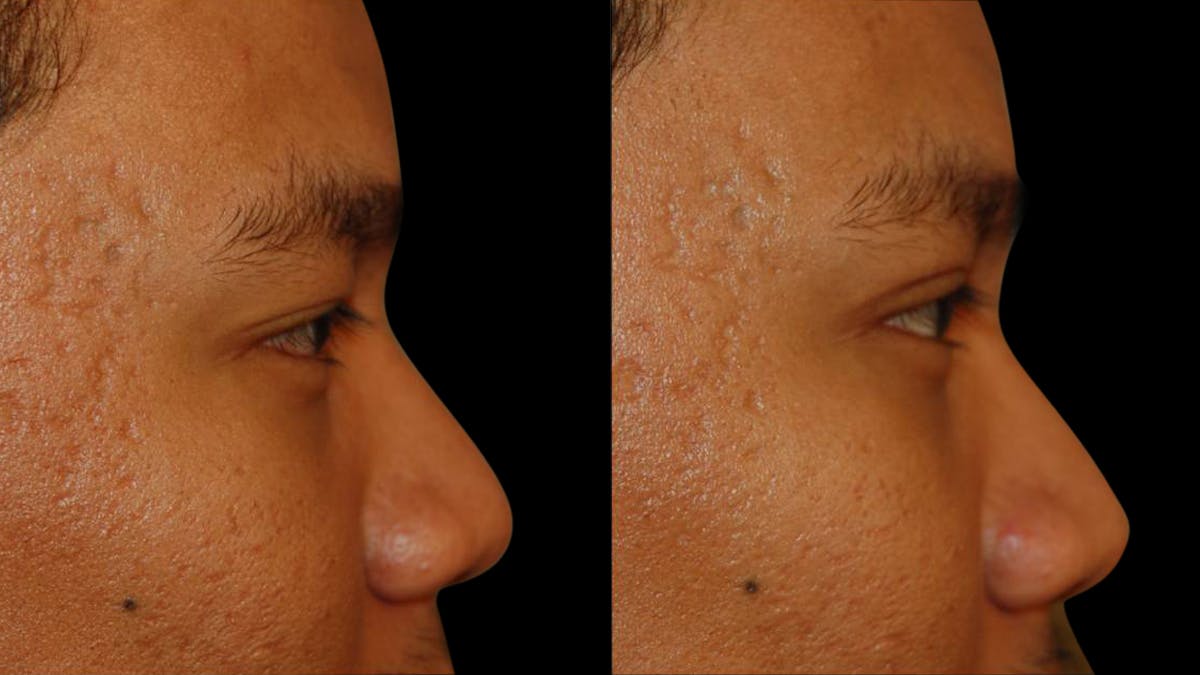 Asian Eyelid Surgery Before & After Gallery - Patient 258927 - Image 9