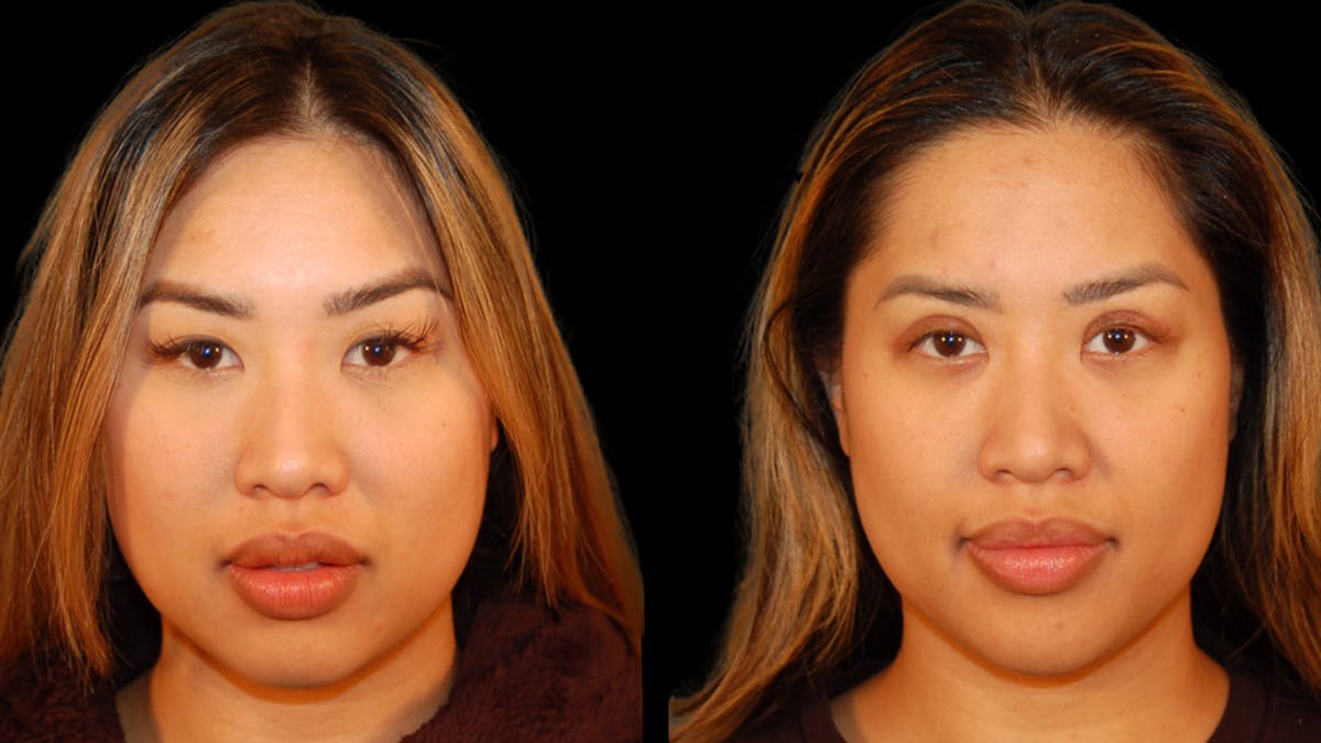 Asian Eyelid Surgery Before & After Gallery - Patient 947537 - Image 1
