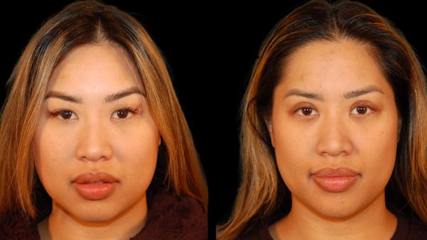 Asian Eyelid Surgery Before & After Gallery - Patient 947537 - Image 1