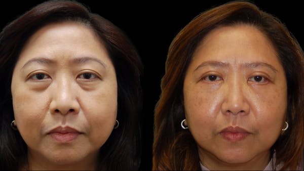 Asian Eyelid Surgery Before & After Gallery - Patient 407147 - Image 1