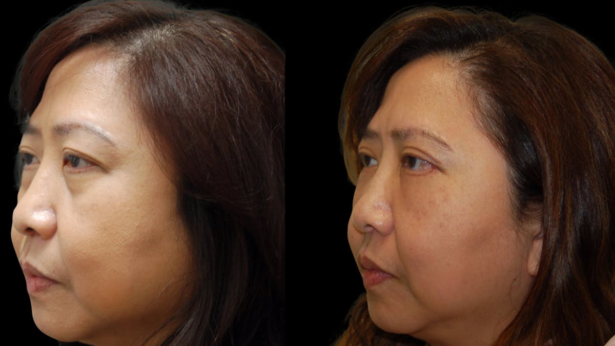 Asian Eyelid Surgery Before & After Gallery - Patient 407147 - Image 2