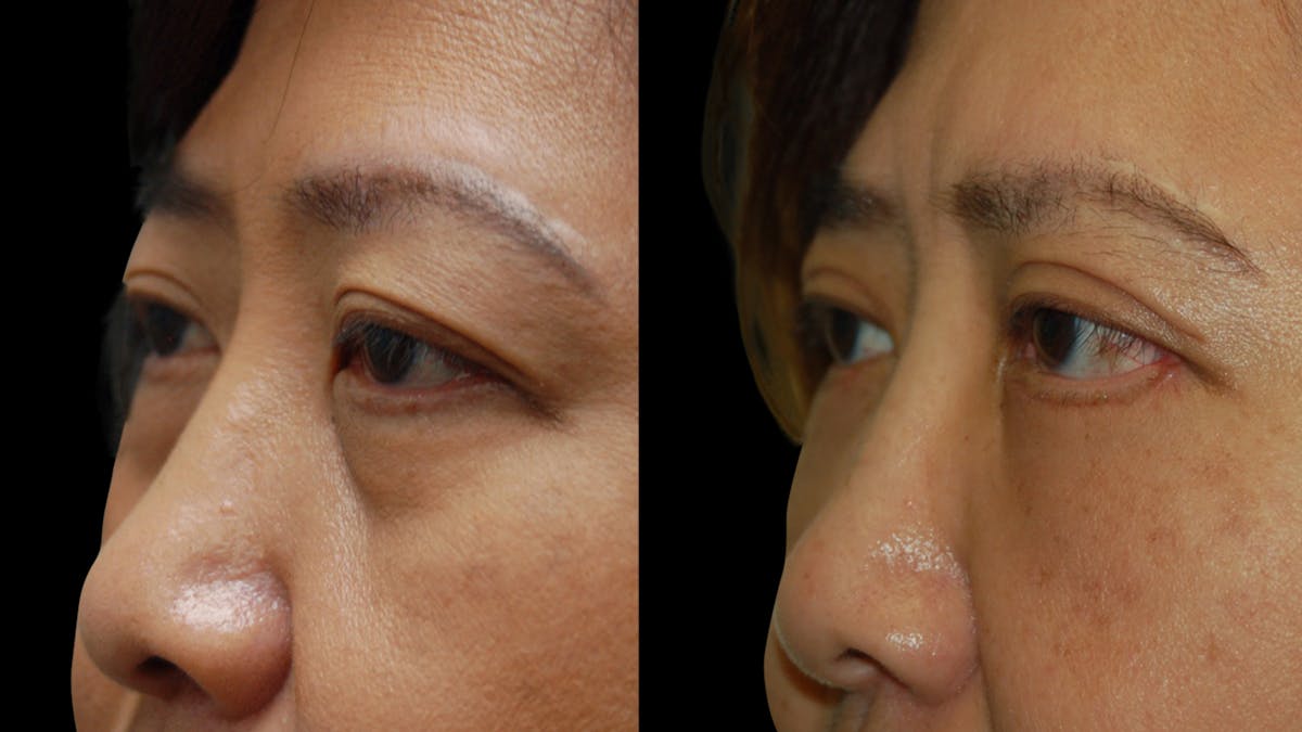 Asian Eyelid Surgery Before & After Gallery - Patient 407147 - Image 3
