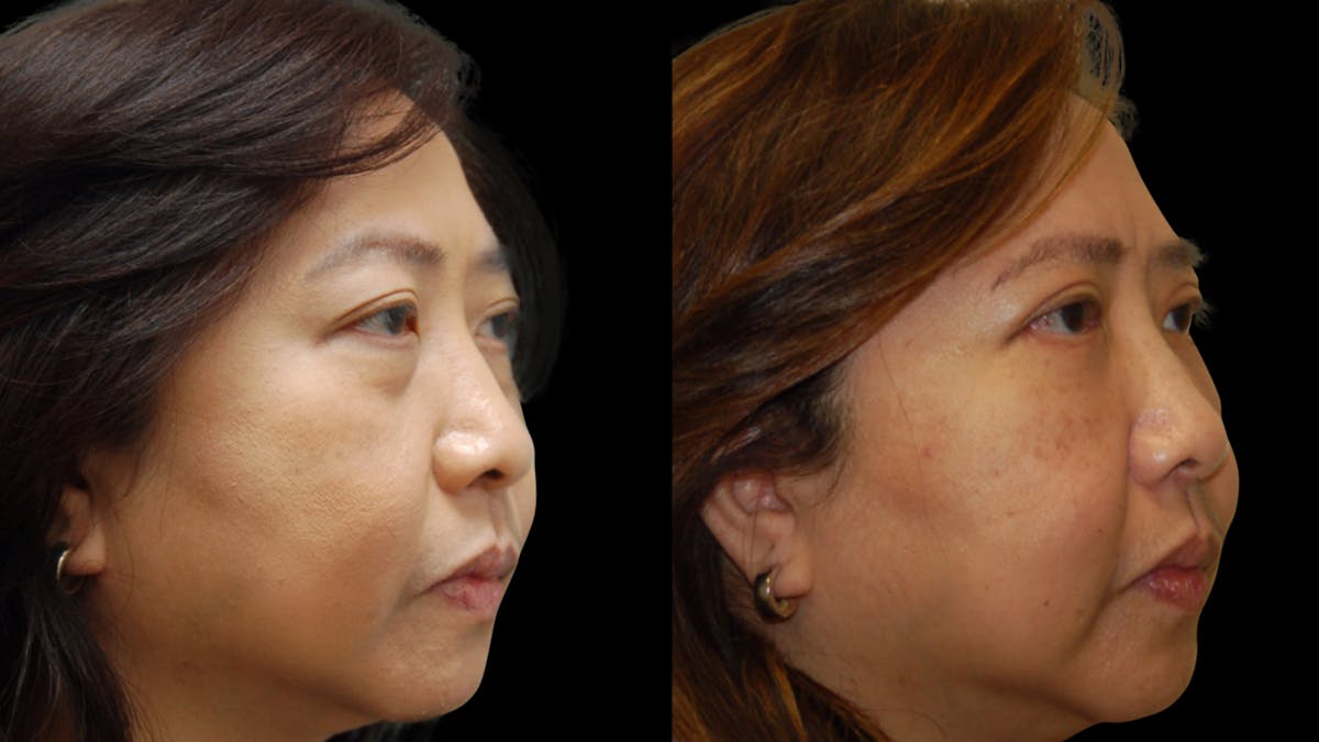 Asian Eyelid Surgery Before & After Gallery - Patient 407147 - Image 4