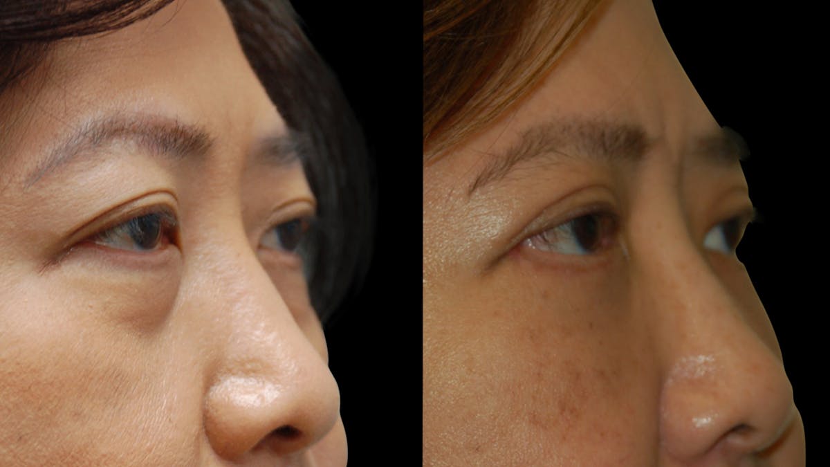 Asian Eyelid Surgery Before & After Gallery - Patient 407147 - Image 5