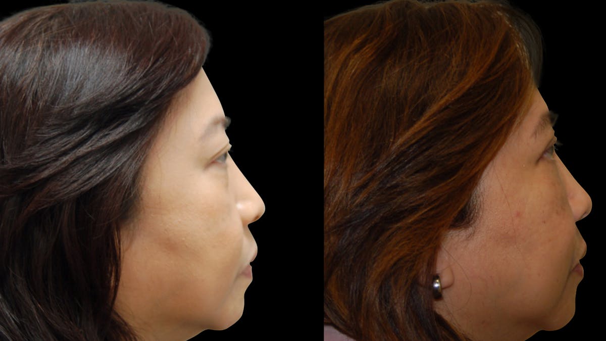 Asian Eyelid Surgery Before & After Gallery - Patient 407147 - Image 6