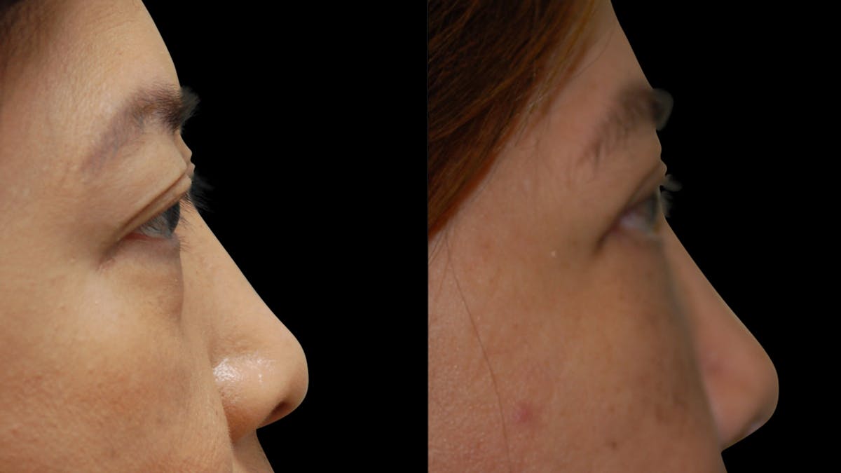 Asian Eyelid Surgery Before & After Gallery - Patient 407147 - Image 7