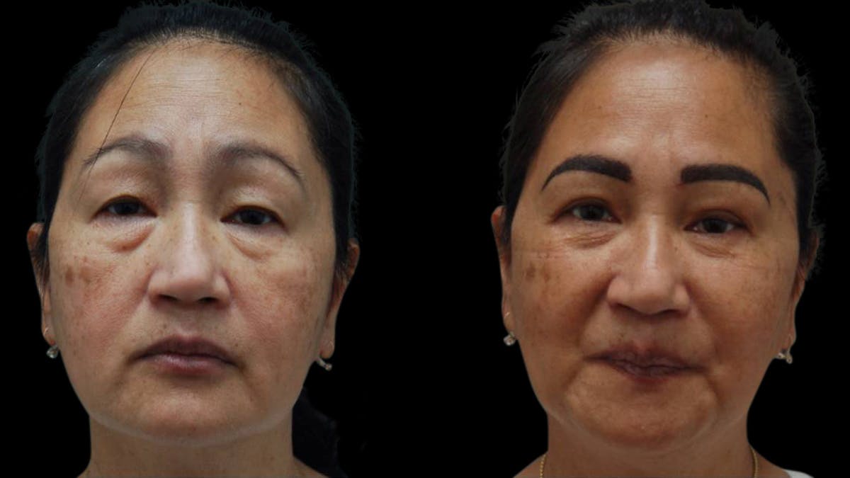 Asian Eyelid Surgery Before & After Gallery - Patient 126200 - Image 1