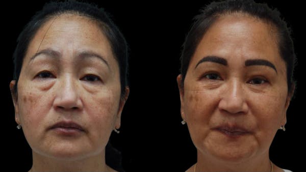 Asian Eyelid Surgery Before & After Gallery - Patient 126200 - Image 1
