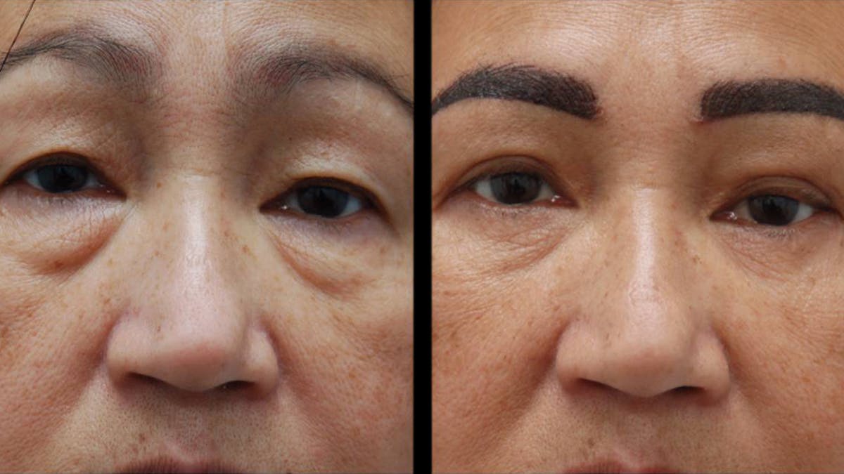 Asian Eyelid Surgery Before & After Gallery - Patient 126200 - Image 2