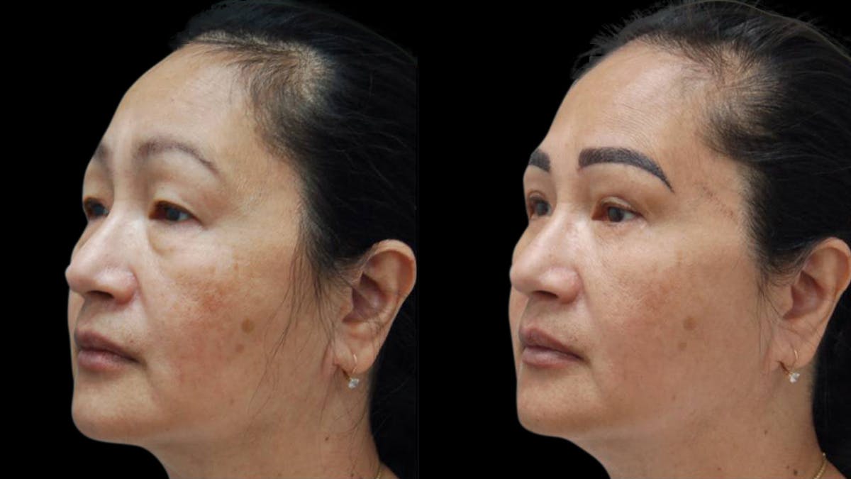 Asian Eyelid Surgery Before & After Gallery - Patient 126200 - Image 3