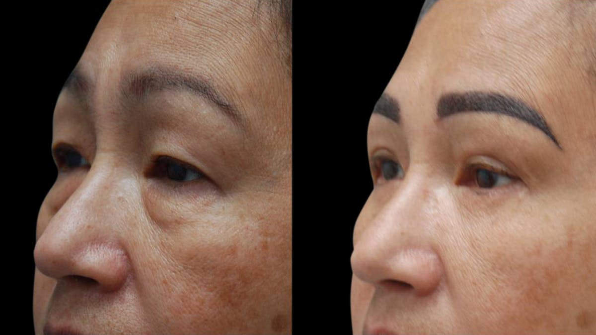 Asian Eyelid Surgery Before & After Gallery - Patient 126200 - Image 4