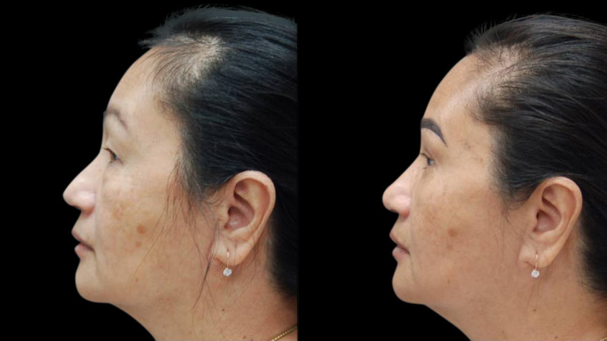 Asian Eyelid Surgery Before & After Gallery - Patient 126200 - Image 5