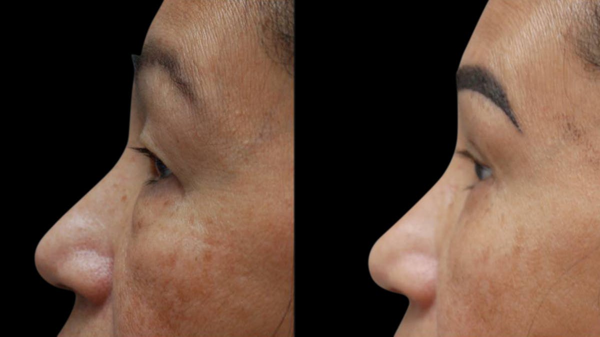 Asian Eyelid Surgery Before & After Gallery - Patient 126200 - Image 6