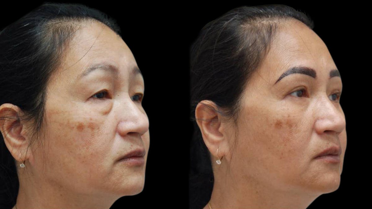 Asian Eyelid Surgery Before & After Gallery - Patient 126200 - Image 7