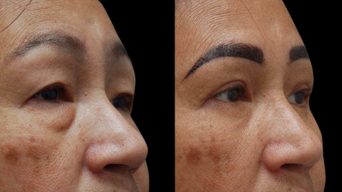 Asian Eyelid Surgery Before & After Gallery - Patient 126200 - Image 8