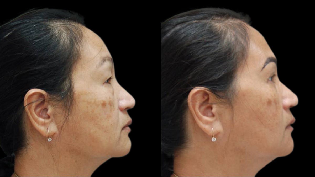 Asian Eyelid Surgery Before & After Gallery - Patient 126200 - Image 9